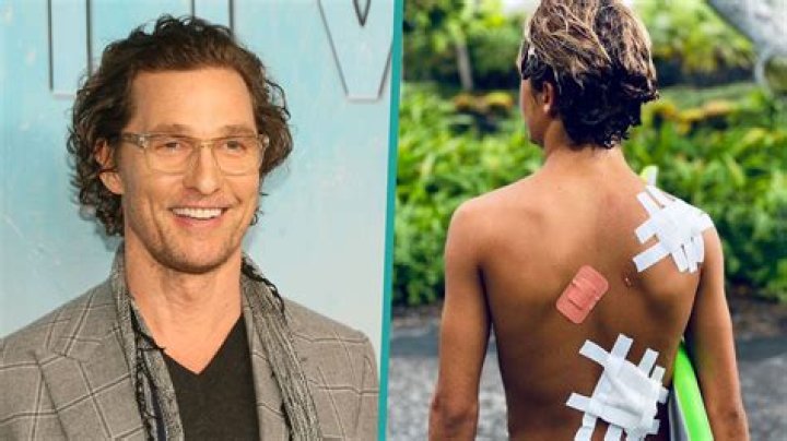 Matthew McConaughey’s Son Levi, 14, Reveals His Surf Injuries: ‘Souvenirs’