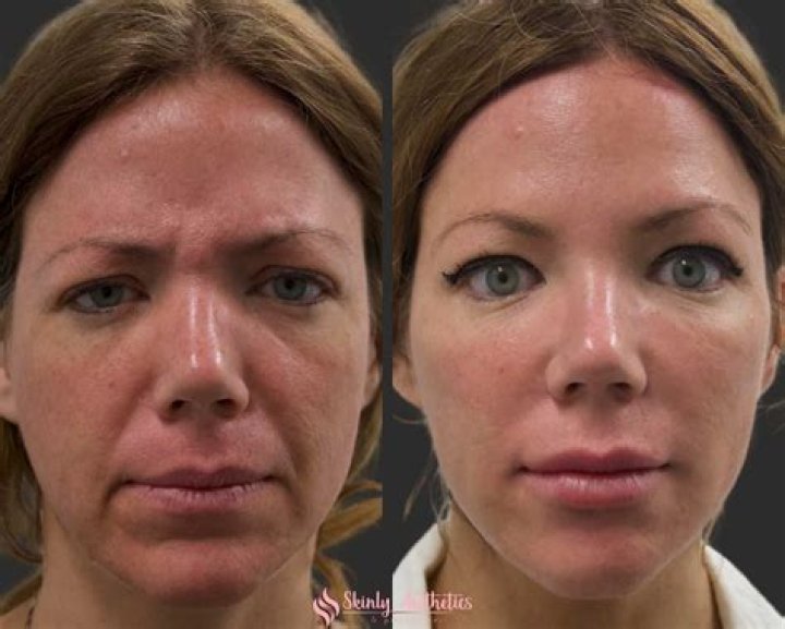 Unnatural Looks By Botox, Facelift, Cheekbone Procedure!